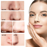 Hydrocolloid Deep Clean Pore Nose Patch Strip 12 PCS