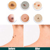 Skin Tag Removal Patches