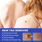 Wart or Skin Tag Remover Kit